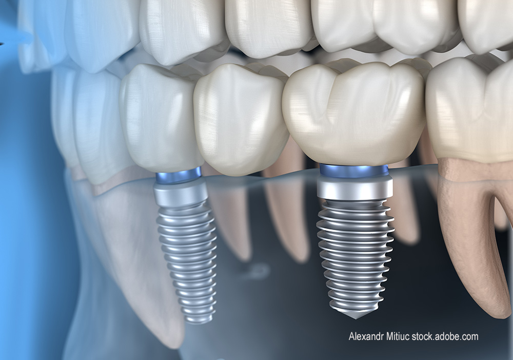 Implantate, ©Alexandr Mitiuc - stock.adobe.com Computerdarstellung von einem Gebiss. Man sieht die Implantatschrauben, die im Zahnfleisch sind, da das Zahnfleisch hier durchsichtig dargestellt wird.